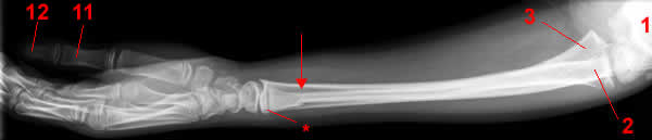 Forearm X-ray, Lateral projection.