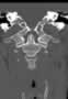 Level 4. CT of the Craniocervical junction, coronal reconstruction.