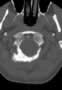 Level 1. CT of the Craniocervical junction, axial reconstruction.