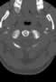 Level 3. CT of the Craniocervical junction, axial reconstruction.