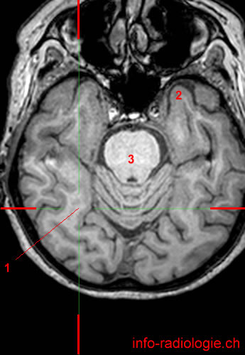 Occipital Lobe Mri 6670