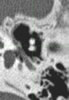 CT of middle ear- Image 10