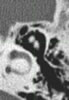CT of middle ear- Image 16