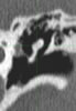 CT of middle ear- Image 14