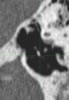 CT of middle ear- Image 3