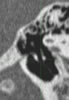 CT of middle ear- Image 6
