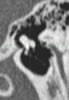 CT of middle ear- Image 12