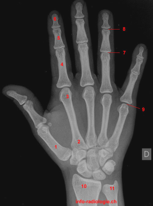 Hand radiography - AP projection
