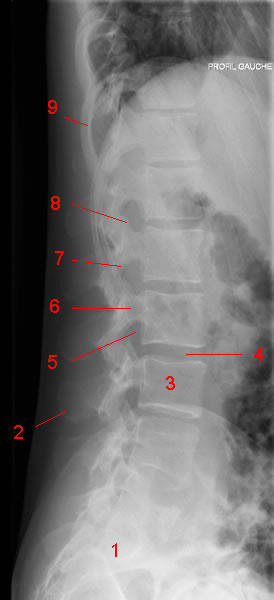 Lumbar spine X-ray, lateral view