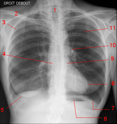 Chest X-ray: AP Projection.
