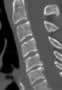 Level 6 de 6 (Dernière image). CT of the Cervical Spine, sagittal reconstruction.
