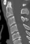 Level 1. CT of the Cervical Spine, sagittal reconstruction.