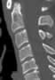 Level 2. CT of the Cervical Spine, sagittal reconstruction.