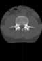 Level 2. CT of lumbar Spine, axial reconstruction