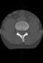 Level 8. CT of lumbar Spine, axial reconstruction