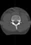 Level 6. CT of lumbar Spine, axial reconstruction