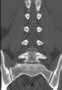 Level 2. CT of lumbar Spine, coronal reconstruction
