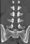 Level 3. CT of lumbar Spine, coronal reconstruction