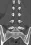 Level 8. CT of lumbar Spine, coronal reconstruction