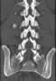 Level 1. CT of lumbar Spine, coronal reconstruction