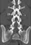 Level 4. CT of lumbar Spine, coronal reconstruction