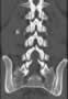 Level 6. CT of lumbar Spine, coronal reconstruction