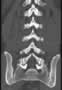 Level 5. CT of lumbar Spine, coronal reconstruction.