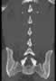 Level 7. CT of lumbar Spine, coronal reconstruction.