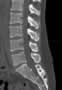 Level 2. CT of lumbar Spine, sagittal reconstruction