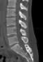 Level 3. CT of lumbar Spine, sagittal reconstruction