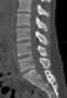 Level 1. CT of lumbar Spine, sagittal reconstruction