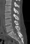 Level 4. CT of lumbar Spine, sagittal reconstruction