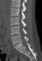 Level 6. CT of lumbar Spine, sagittal reconstruction