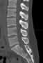 Level 5. CT of lumbar Spine, sagittal reconstruction.