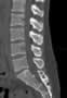Level 7. CT of lumbar Spine, sagittal reconstruction.