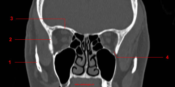 superior orbital fissure radiology